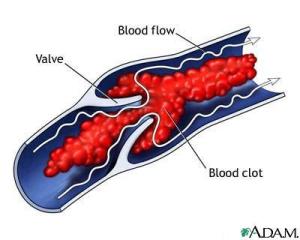 Blood clot