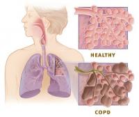 Biomarker for the detection of chronic obstructive pulmonary disease